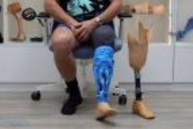 3D Scanning of Leg